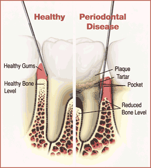 Periodontal Gum Diseases