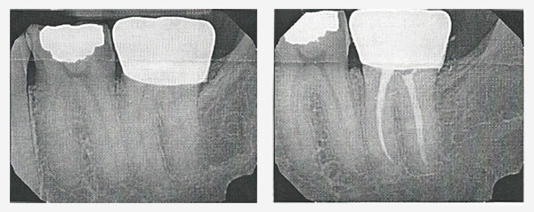 Root Canal Therpy X ray